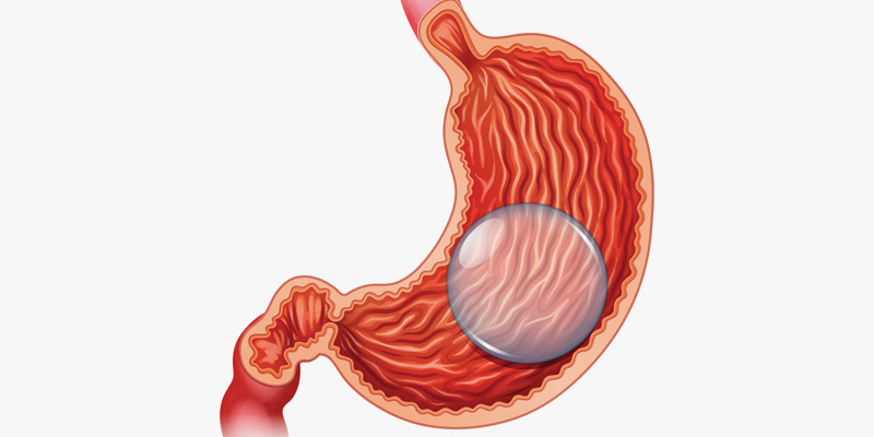 Medispar gastric balloon